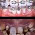 Restore Bad Teeth And Braces Braces Orthodontist Dentist Teeth