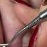 Foot Restoration Fixing Thick Toenails Calluses And Athlete S Foot Meticulous Manicurist
