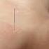 SHOULDER PAIN RELIEF With Dry Needling And ESTIM