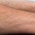 Thompson Test Achilles Tendon Rupture Tear