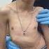 Scoliosistreatment Drrajneeshkant Rkm