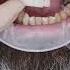 Dental Implant S In Prague Shorts Dentist Dental Implant Veneers Short