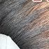 Thinning Hair 4 Hormone Deficiencies