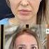 SCAR HEALING OF FOREHEAD REDUCTION Dr Ahmet Dilber Foreheadreduction Hairlinelowering
