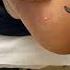 Expert Australian Podiatrist Removes Painful Corns With Precision