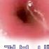 자궁경부내시경