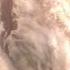 Using An Endoscopy To Clean Fungal Otitis Externa 20250313