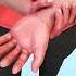How Bee Sting Therapy Works