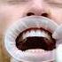 Non Prep Lumineers Treatment From Sevil Smile Studio