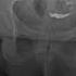 Retrospective Hysterosalpingogram HSG X Ray Exam View Of Uterus And Fallopian Tubes