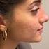 Rhinoplasty Turkey Dr Ahmet Dilber Rhinoplastyturkey Plasticsurgery Nosejob