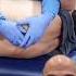 Chiropractic Adjustment Of Severe Hunchback Chiropractor Hunchback Viral Fyp Parati Trending