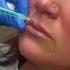 Try A LIP FLIP To Help Achieve A Fuller Top Lip Lipflip Injection Viralvideo Explore