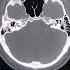 CT SCAN OF PNS Viral Shortfeeds Medical