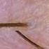Day 3 Of Oana Eflornithine Lets See If It Can Slow Facial Hair Femalechinhair Vaniqa Facialhair