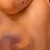 Bruise Update Day 4 New Subs Bruises Shorts Fyp Trending Fypシ Anemia Anemic Bruised