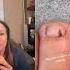 Dr Pimple Popper Vs A Small Splinter
