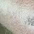 Rare Bacterial Infection Strikes Florida Man After Lake Dora Jet Ski Injury