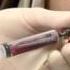 Bone Marrow Aspiration And Biopsy From The Iliac Crest Oncolex