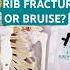 Broken Rib Or Bruised Rib How To Tell The Difference