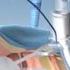 Portex ULTRAperc Percutaneous Dilation Tracheostomy Kit