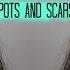 How To Cover Acne Scars And Spots In Less Than 5 Minutes