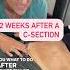 What To Do 2 Weeks After A C Section Csectionrecovery Csection