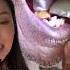 Biggest Salivary Stone I Ve Ever Seen Salivarystone Tonsilstone Mouthstone Mouthsore Dentist