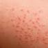 Doctor Explains HEAT RASH Miliaria In A Baby Causes Symptoms Treatment And Prevention