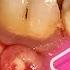 Very Satisfying To Pop The Dental Abscess Out Dentist Dokter Gigi Tri Putra