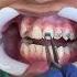 Putting Braces On