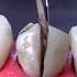 Cracked Tooth