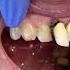 Broken Crown Broken Tooth