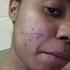 A REVIEW ABOUT ZINERYT HOW TO PUT IT ON YOUR FACE FOR ACNE