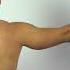 Drop Arm Test Sign Supraspinatus Tear