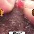Wow Pimplepopping Pimple Pimples Shortsfeed Shortvideo Shorts Short Youtube Youtubeshorts