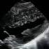 Ventricular Fibrillation V Fib On Echo A Deadly Arrhythmia Leading To Cardiac Arrest