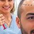 I Got A 6 000 Hair Transplant In Türkiye