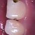 Remove Cavity Form Teeth Dental Caries Cavity Filling