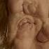 Campaign Against Hate Crimes For People With Physical Disfigurements