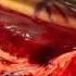 Open Surgical Repair Of A Ruptured Achilles Tendon