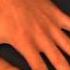 Game Keepers Thumb Test