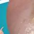 Mummified Ear Wax Extraction You Won T Believe This EP1154