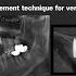 A Soft Tissue Management Technique For Vertical Ridge Defect