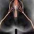 The Cause Of Sciatica