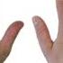 What Is Guyon S Canal Syndrome