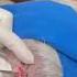 Here You Go A Pilar Cyst Extraction Straight From The Scalp
