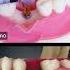 How Is Dental Implant
