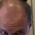BALDING IN MY 20 S Head Shave BEFORE AFTER