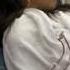 Sickle Cell Anemia A Patient S Journey
